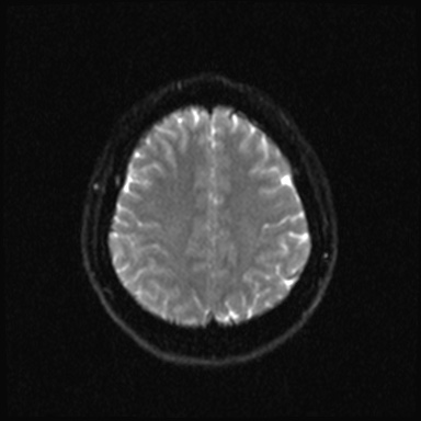 Cavernous sinus meningioma (Radiopaedia 63682-72367 DWI 17).jpg