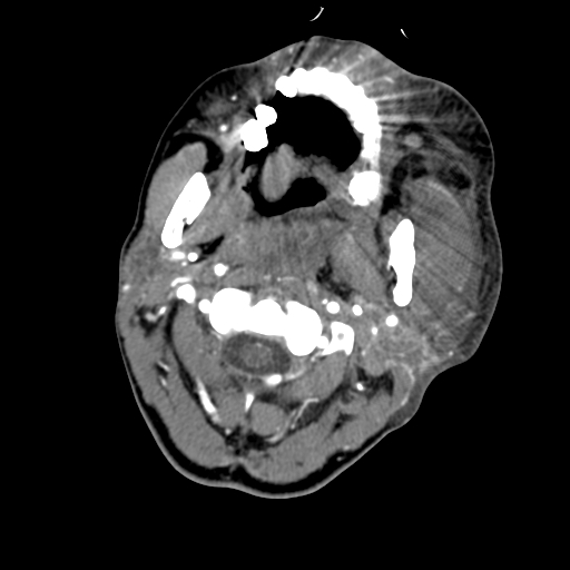 File:Cavernous sinus thrombosis (Radiopaedia 10619-11078 A 12).jpg