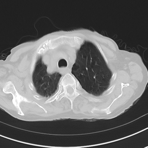 Cavitating pneumonia - lingular segments (Radiopaedia 34386-35678 Axial lung window 13).png