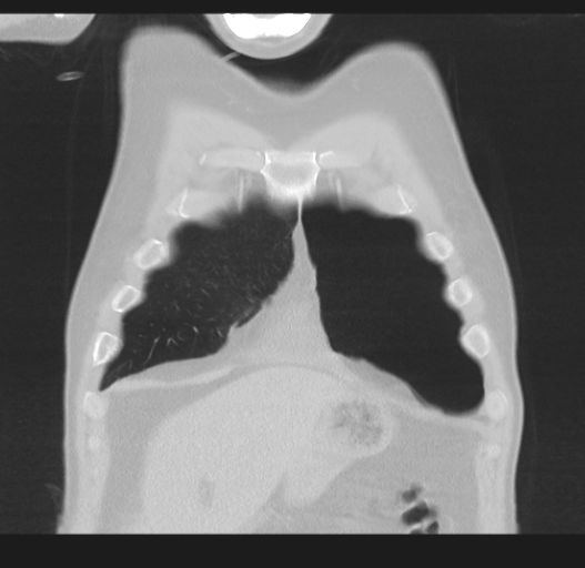 Cavitating pneumonia complicated by pneumothorax (Radiopaedia 48149-52994 Coronal lung window 11).png