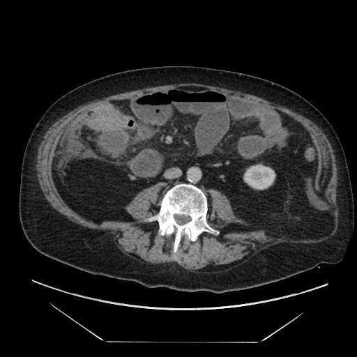 Cecal adenocarcinoma (Radiopaedia 64871-73817 A 55).jpg