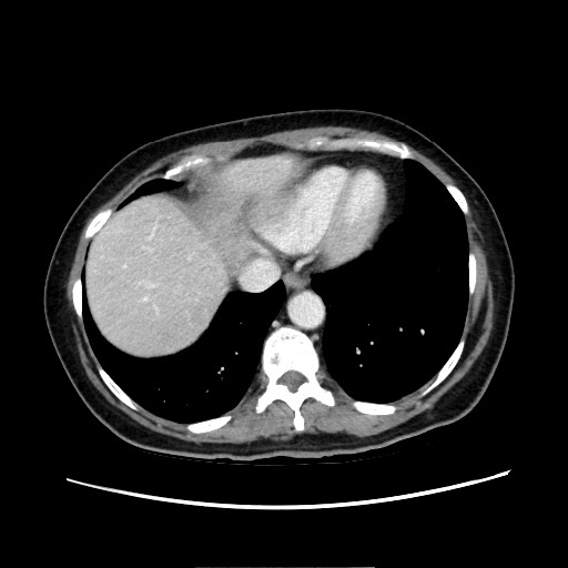 Cecal adenocarcinoma (Radiopaedia 75909-87331 A 16).jpg