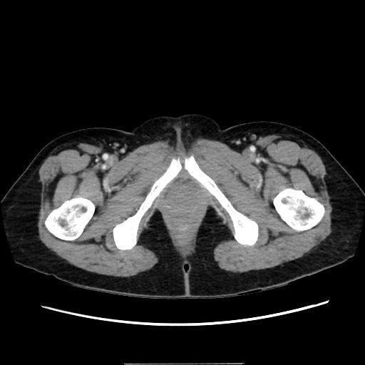 Cecal adenocarcinoma (Radiopaedia 75909-87331 A 91).jpg