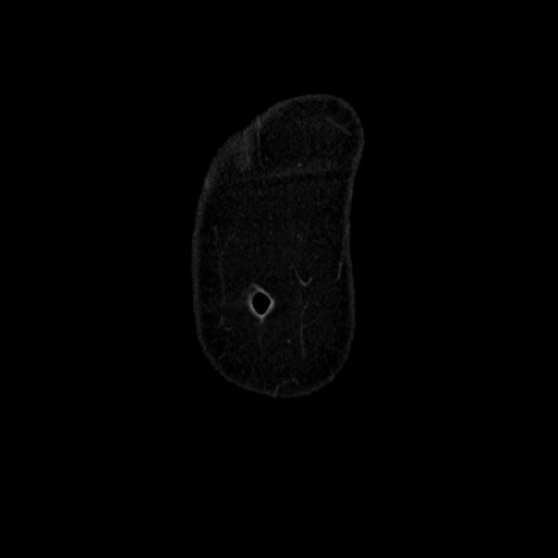 Cecal adenocarcinoma (Radiopaedia 75909-87331 B 4).jpg