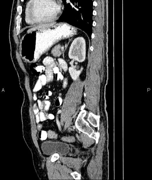 File:Cecal cancer with appendiceal mucocele (Radiopaedia 91080-108651 E 64).jpg