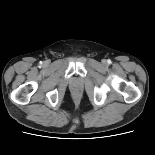 Cecal mass causing appendicitis (Radiopaedia 59207-66531 A 90).jpg