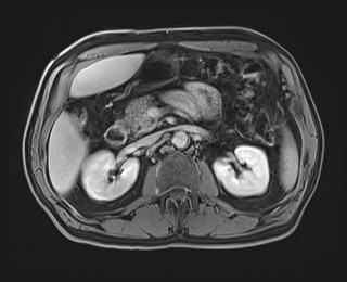 Cecal mass causing appendicitis (Radiopaedia 59207-66532 J 54).jpg