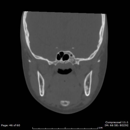 File:Central giant cell granuloma (Radiopaedia 45612-49754 Coronal bone window 46).jpg