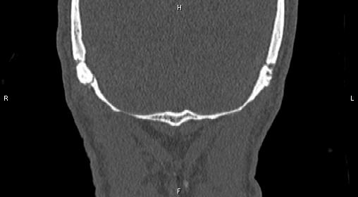 File:Central giant cell granuloma (Radiopaedia 83346-97761 Coronal bone window 47).jpg