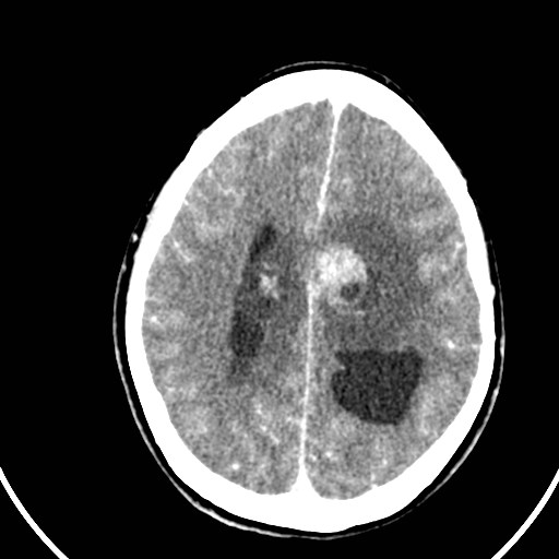 Central neurocytoma (Radiopaedia 84497-99871 B 33).jpg