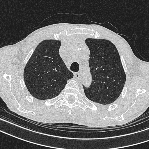 Central venous catheter tip extravasation (Radiopaedia 82828-97113 Axial lung window 23).jpg