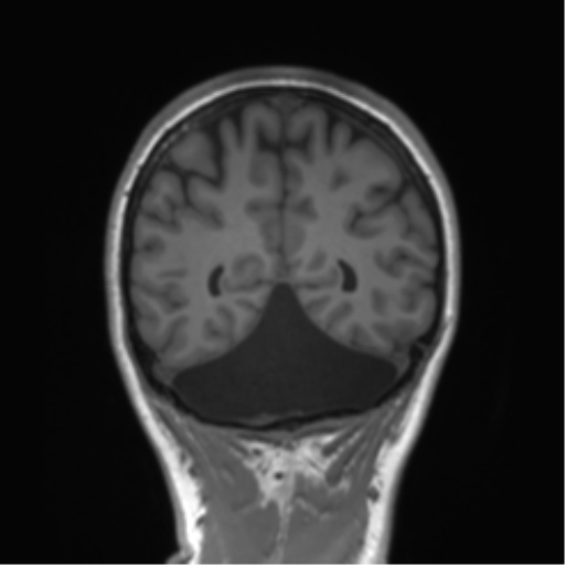 Cerebellar agenesis with hypoplastic pons (pontocerebellar hypoplasia) (Radiopaedia 57224-64138 Coronal T1 27).png