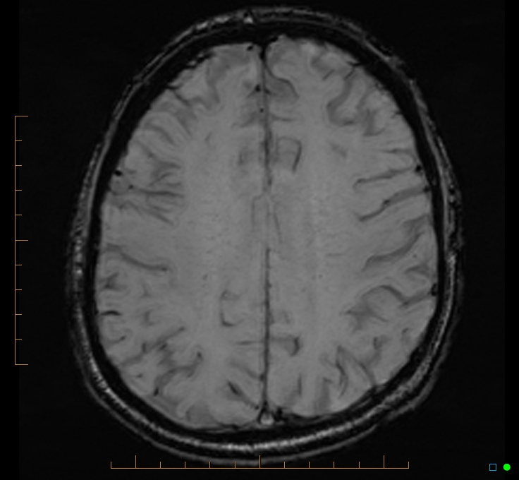 Cerebellar gangliocytoma (Radiopaedia 65377-74422 Axial SWI 41).jpg