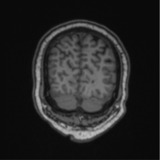 Cerebellar hemangioblastomas and pituitary adenoma (Radiopaedia 85490-101176 Coronal T1 20).png