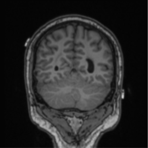 Cerebellar hemangioblastomas and pituitary adenoma (Radiopaedia 85490-101176 Coronal T1 29).png