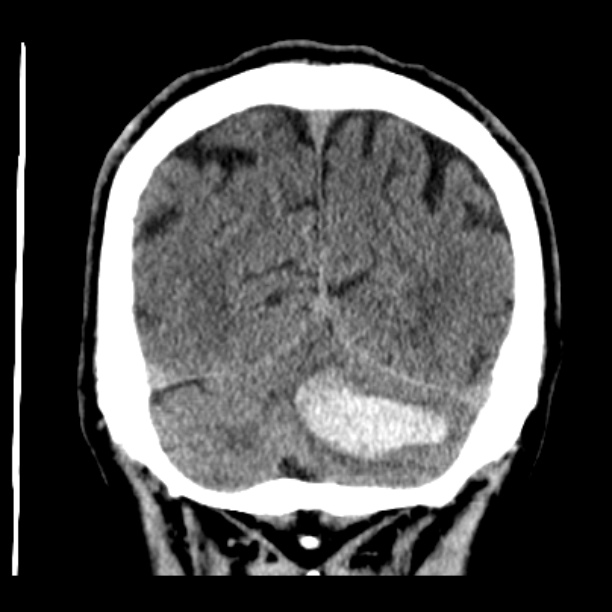 Cerebellar hemorrhage (Radiopaedia 27193-27359 Coronal non-contrast 46).jpg