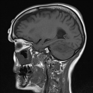 File:Cerebellar metastases (Radiopaedia 24038-24249 Sagittal T1 12).jpg