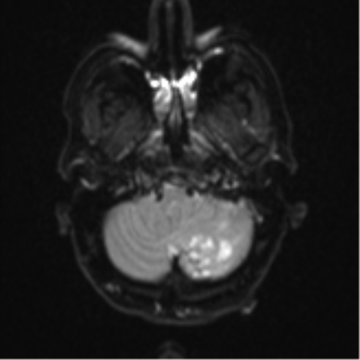 Cerebellar metastasis (Radiopaedia 51137-56765 Axial DWI 5).png