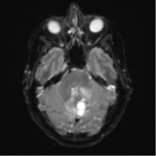 Cerebellar metastasis (Radiopaedia 51137-56765 Axial DWI 9).png