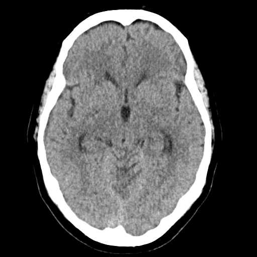 Cerebellar metastasis (Radiopaedia 54578-60812 Axial non-contrast 21).png