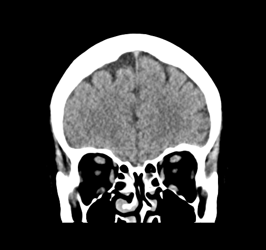 Cerebellar metastasis (Radiopaedia 54578-60812 Coronal non-contrast 12).png