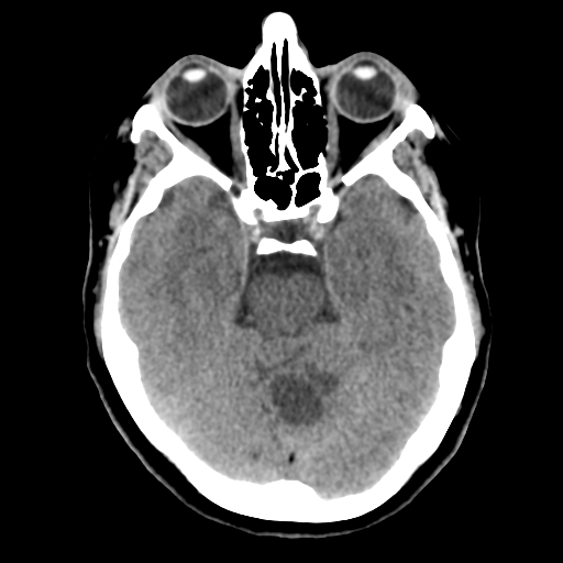 Cerebellar metastasis (cystic appearance) (Radiopaedia 41395-44258 Axial non-contrast 20).png