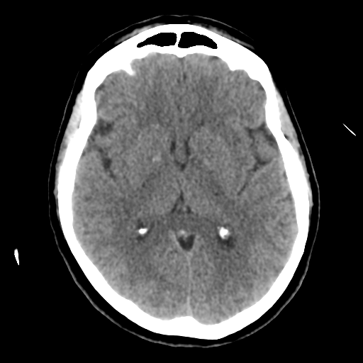 Cerebellar metastasis (cystic appearance) (Radiopaedia 41395-44258 Axial non-contrast 28).png