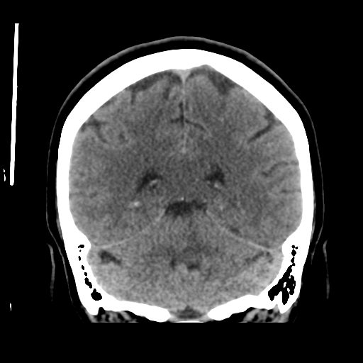 Cerebellar metastasis (cystic appearance) (Radiopaedia 41395-44258 Coronal non-contrast 42).png