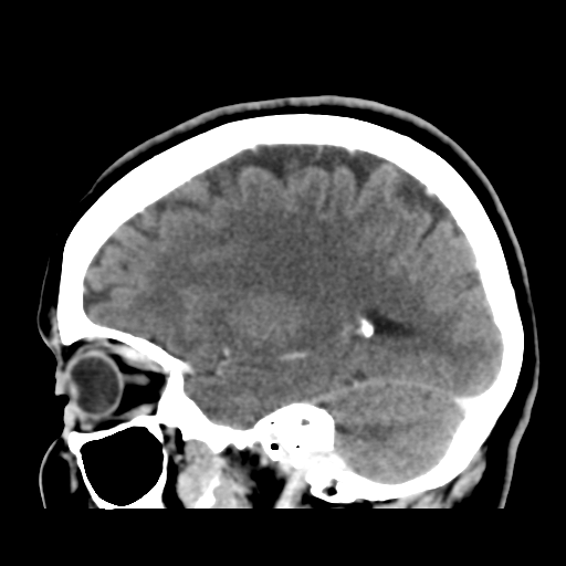 Cerebellar metastasis (cystic appearance) (Radiopaedia 41395-44258 F 36).png
