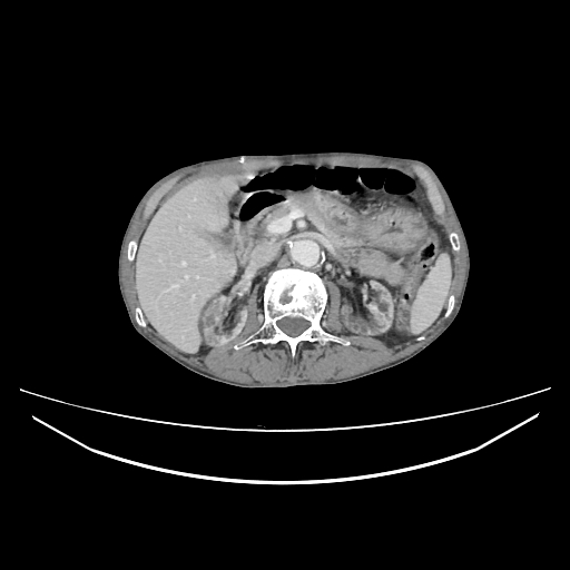 Cerebellar metastasis - lung tumor (Radiopaedia 69317-79150 A 41).jpg
