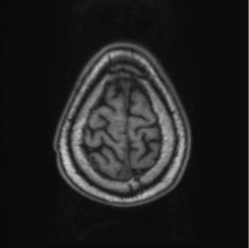 Cerebellar metastasis from lung adenocarcinoma (Radiopaedia 86690-102829 Axial T1 72).png