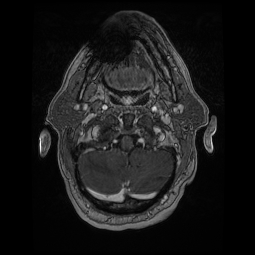 Cerebellar metastasis of pulmonary adenocarcinoma, cavernous venous malformation, and developmental venous anomaly (Radiopaedia 85827-101661 Axial T1 C+ 16).jpg