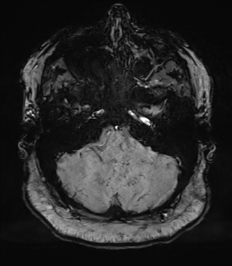 Cerebellopontine angle meningioma (Radiopaedia 48434-53348 Axial SWI 19).png