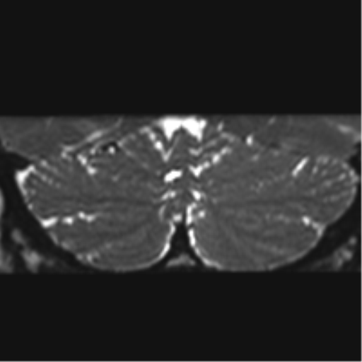 Cerebellopontine angle meningioma (Radiopaedia 48434-53348 Coronal T2 2).png