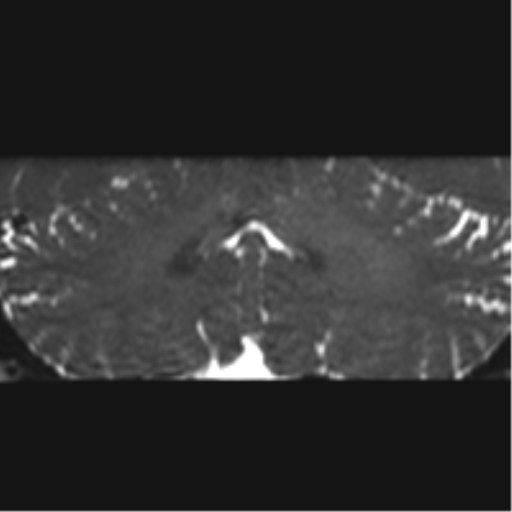 File:Cerebellopontine angle meningioma (Radiopaedia 48434-53348 Coronal T2 22).png