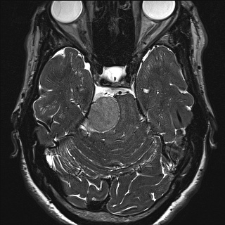 Cerebellopontine angle meningioma (Radiopaedia 72983-83680 Axial FIESTA 49).jpg
