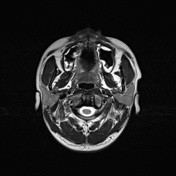 Cerebral abscess (Radiopaedia 24212-24478 Axial T2 6).jpg