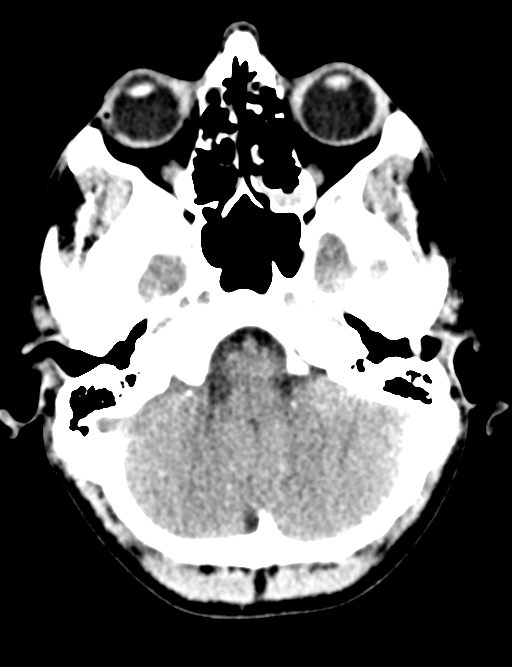 Cerebral abscess (Radiopaedia 60342-68008 Axial non-contrast 11).png