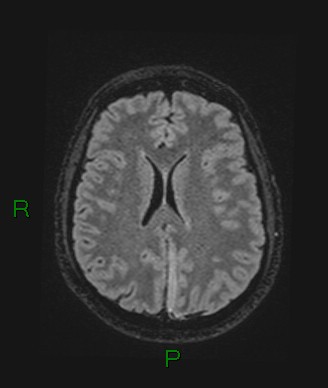 Cerebral abscess and subdural empyema (Radiopaedia 84436-99779 Axial FLAIR 35).jpg