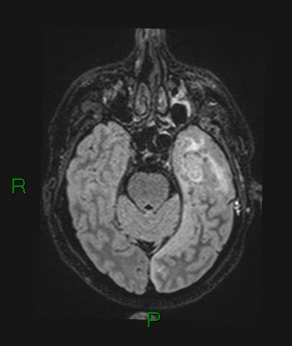 File:Cerebral abscess and subdural empyema (Radiopaedia 84436-99779 Axial FLAIR 58).jpg