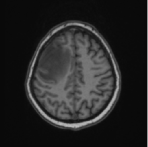 Cerebral abscess from pulmonary arteriovenous malformation (Radiopaedia 86275-102291 Axial T1 56).png