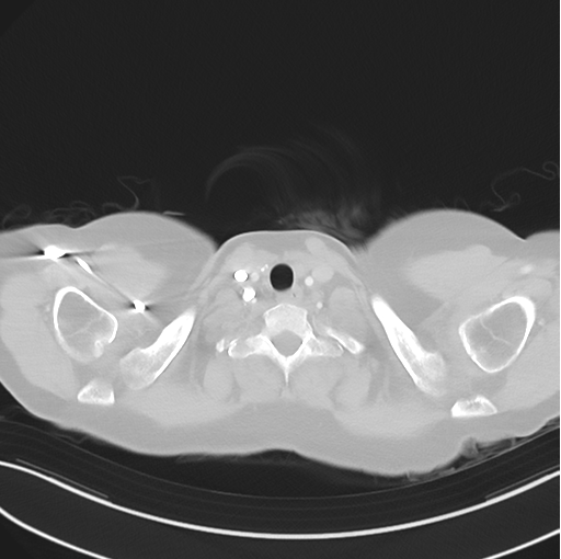 File:Cerebral abscess from pulmonary arteriovenous malformation (Radiopaedia 86275-102292 Axial lung window 5).png