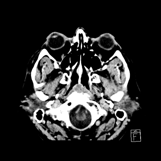 File:Cerebral abscess with ventriculitis (Radiopaedia 78965-91877 A 5).jpg