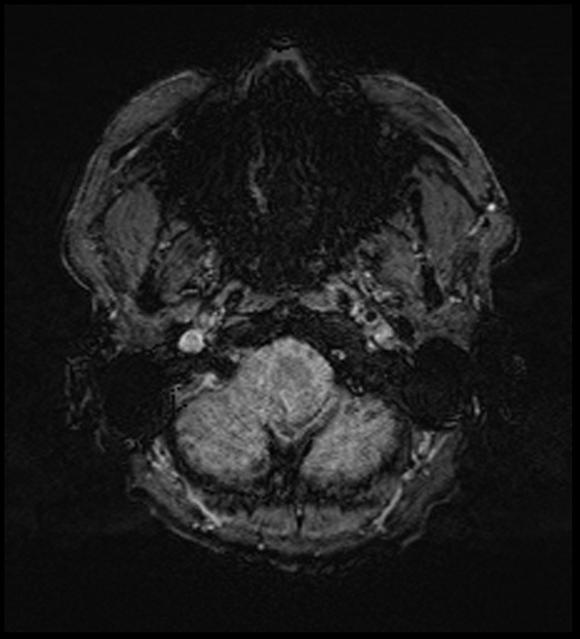 Cerebral abscess with ventriculitis (Radiopaedia 78965-91878 Axial SWI 7).jpg