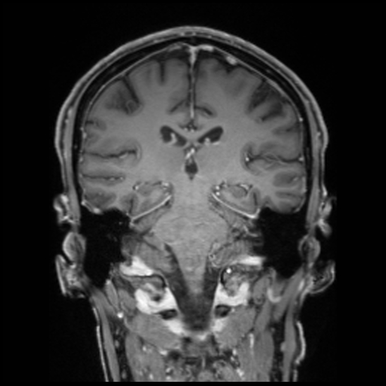 Cerebral abscess with ventriculitis (Radiopaedia 78965-91878 Coronal T1 C+ 38).jpg