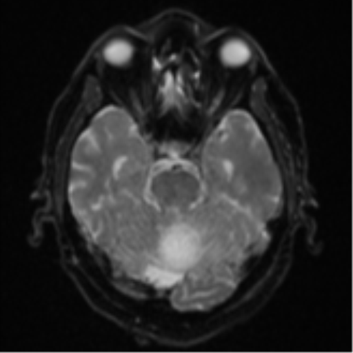 Cerebral abscesses- medically managed (Radiopaedia 45183-49179 Axial DWI 10).png