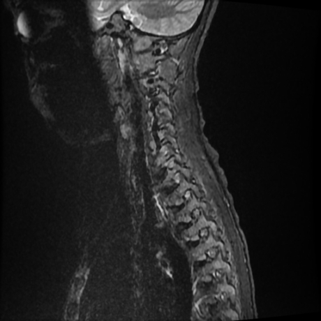 File:Cerebral and spinal tuberculosis (Radiopaedia 90489-107838 Sagittal STIR 2).jpg