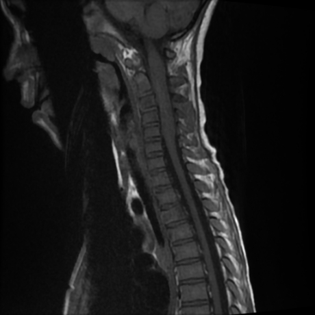 File:Cerebral and spinal tuberculosis (Radiopaedia 90489-107838 Sagittal T1 6).jpg