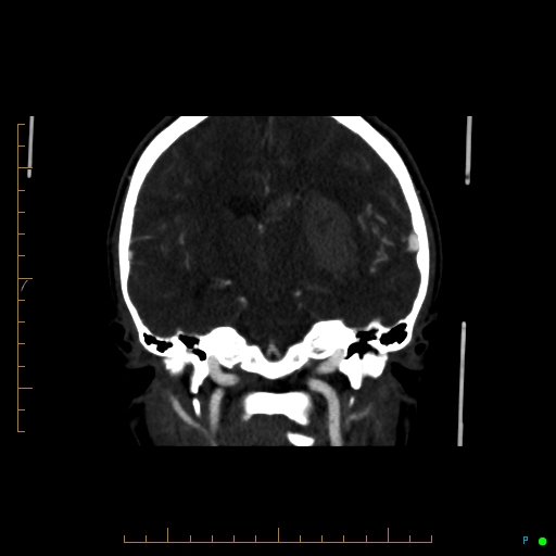 Cerebral arteriovenous malformation (AVM) (Radiopaedia 78162-90706 Coronal CTA 50).jpg