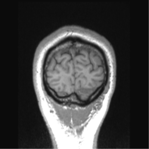 Cerebral arteriovenous malformation (Radiopaedia 39259-41506 Coronal T1 10).png